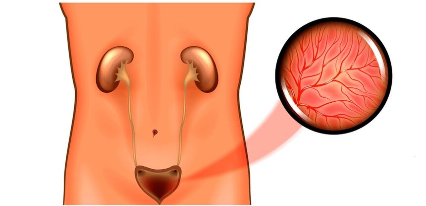 Cystitis in symptoms and treatment of men